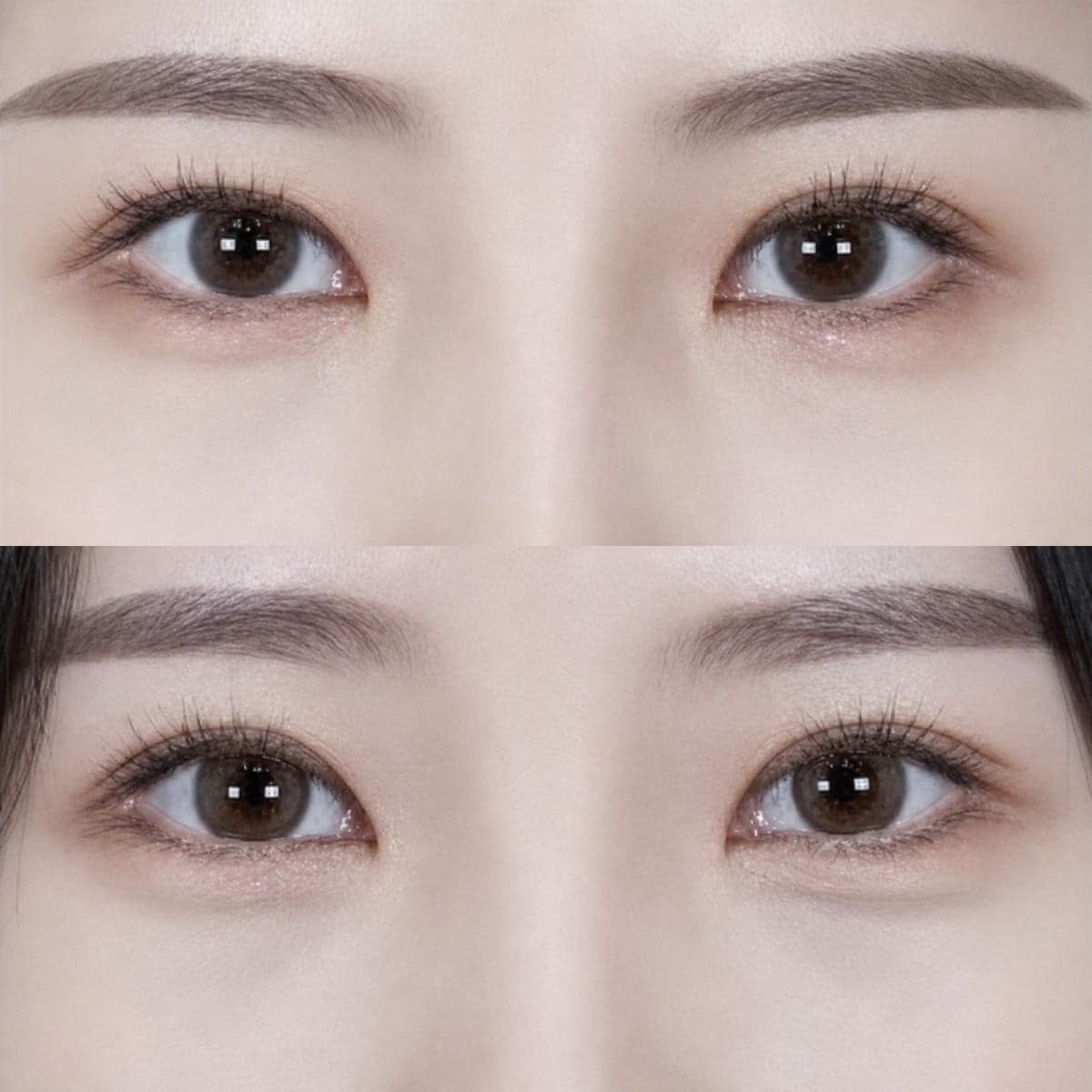blepharoplasty