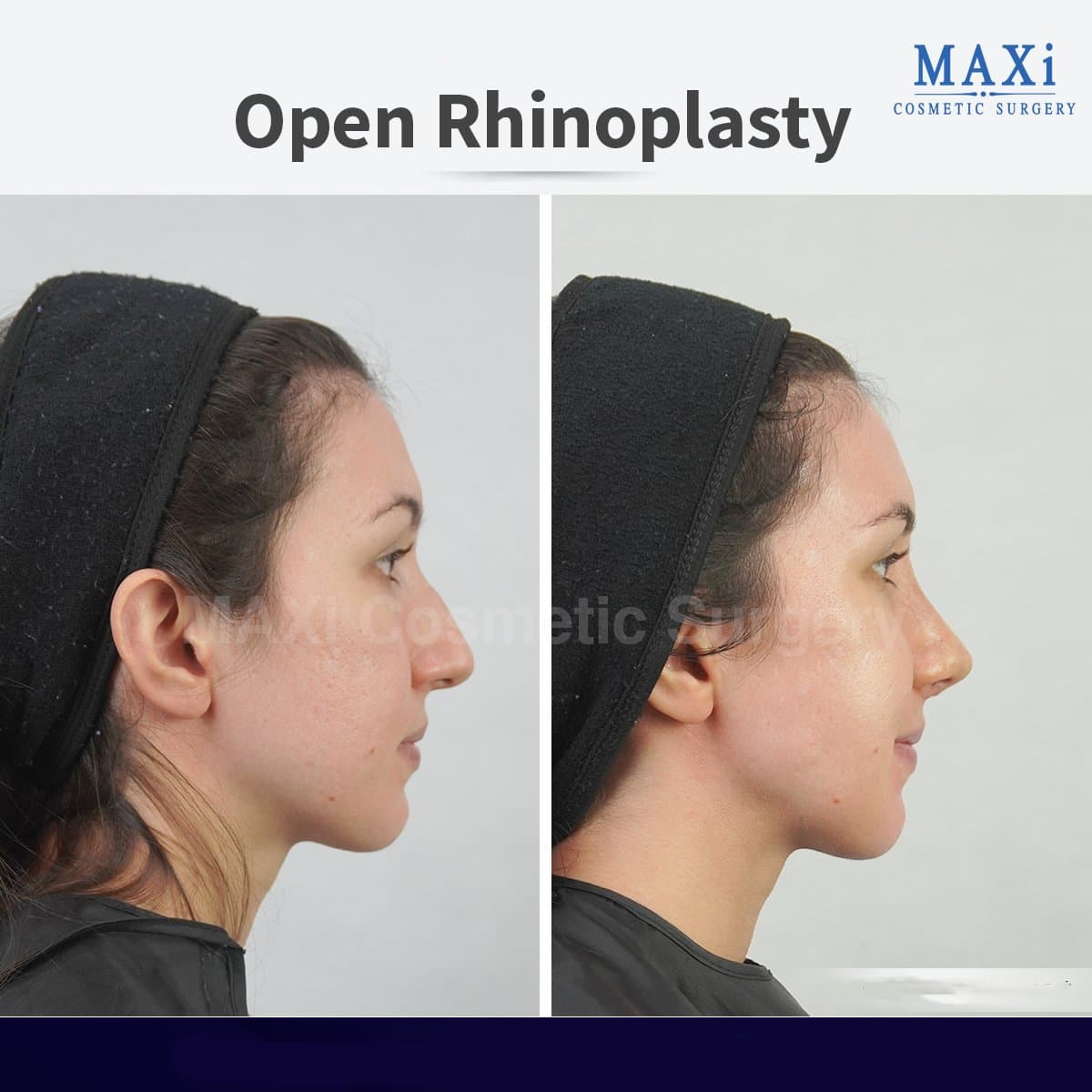 open rhinoplasty