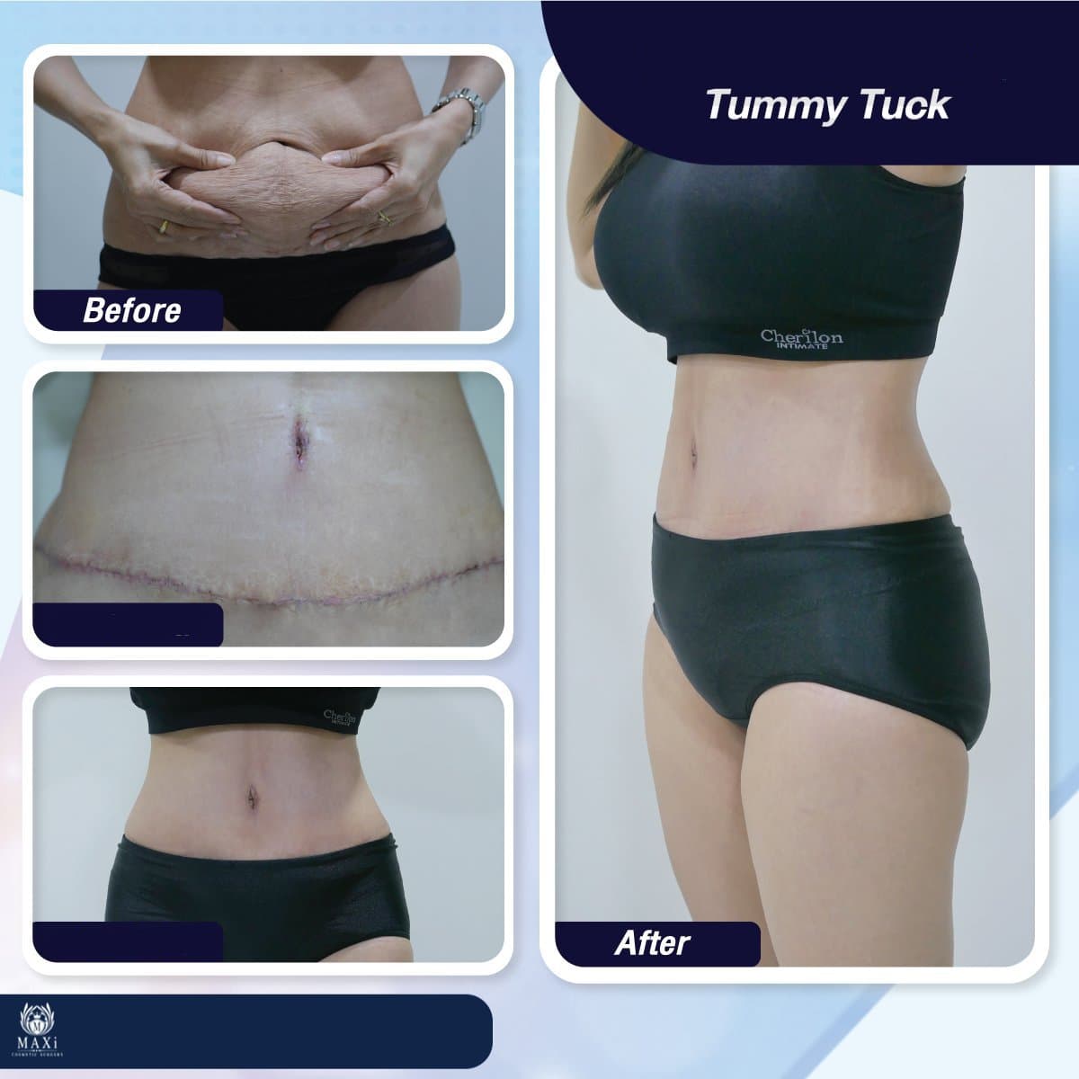 tummy tuck