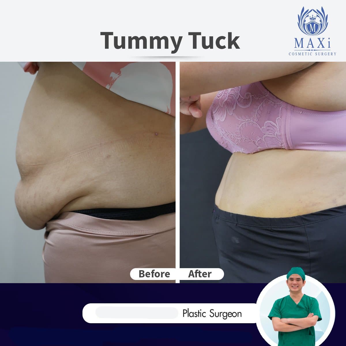 tummy tuck
