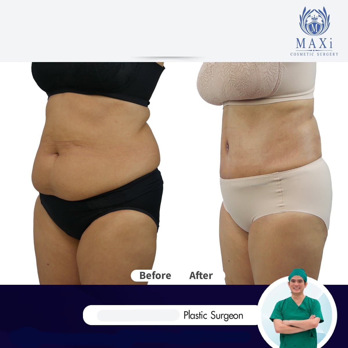 tummy tuck