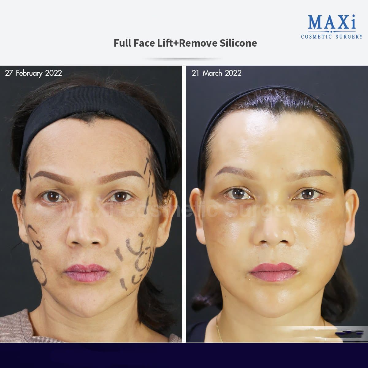 full facelift and silicone removal