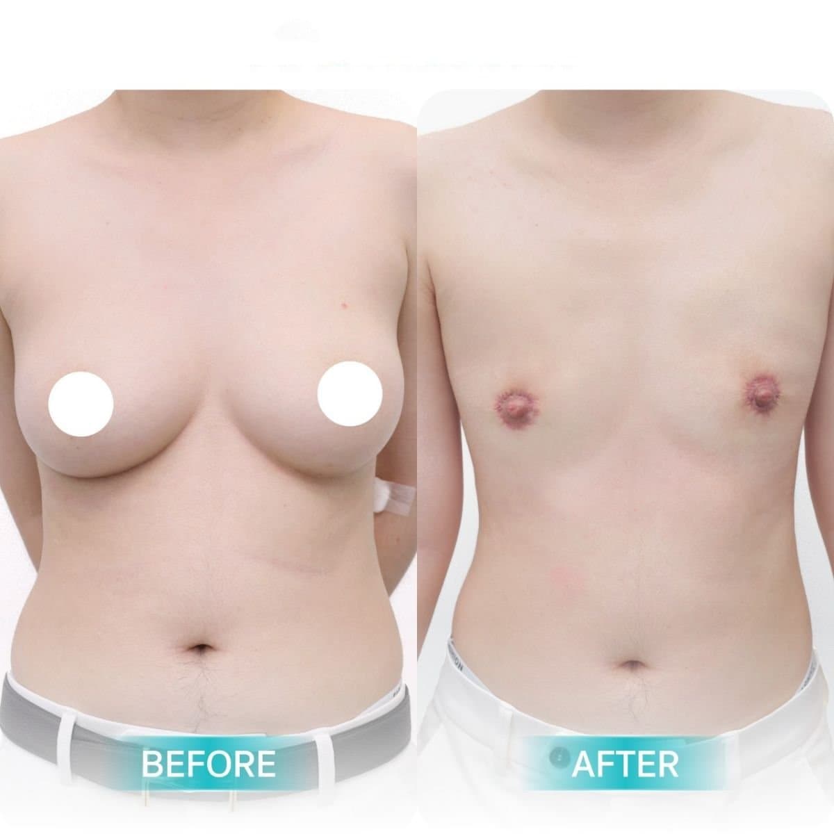 top surgery
