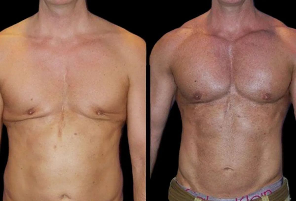 pectoral implants