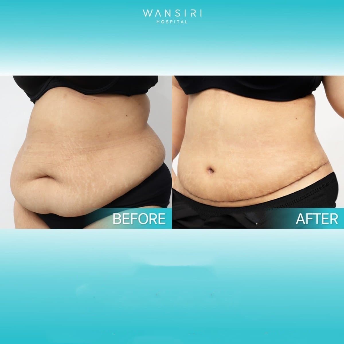 liposuction