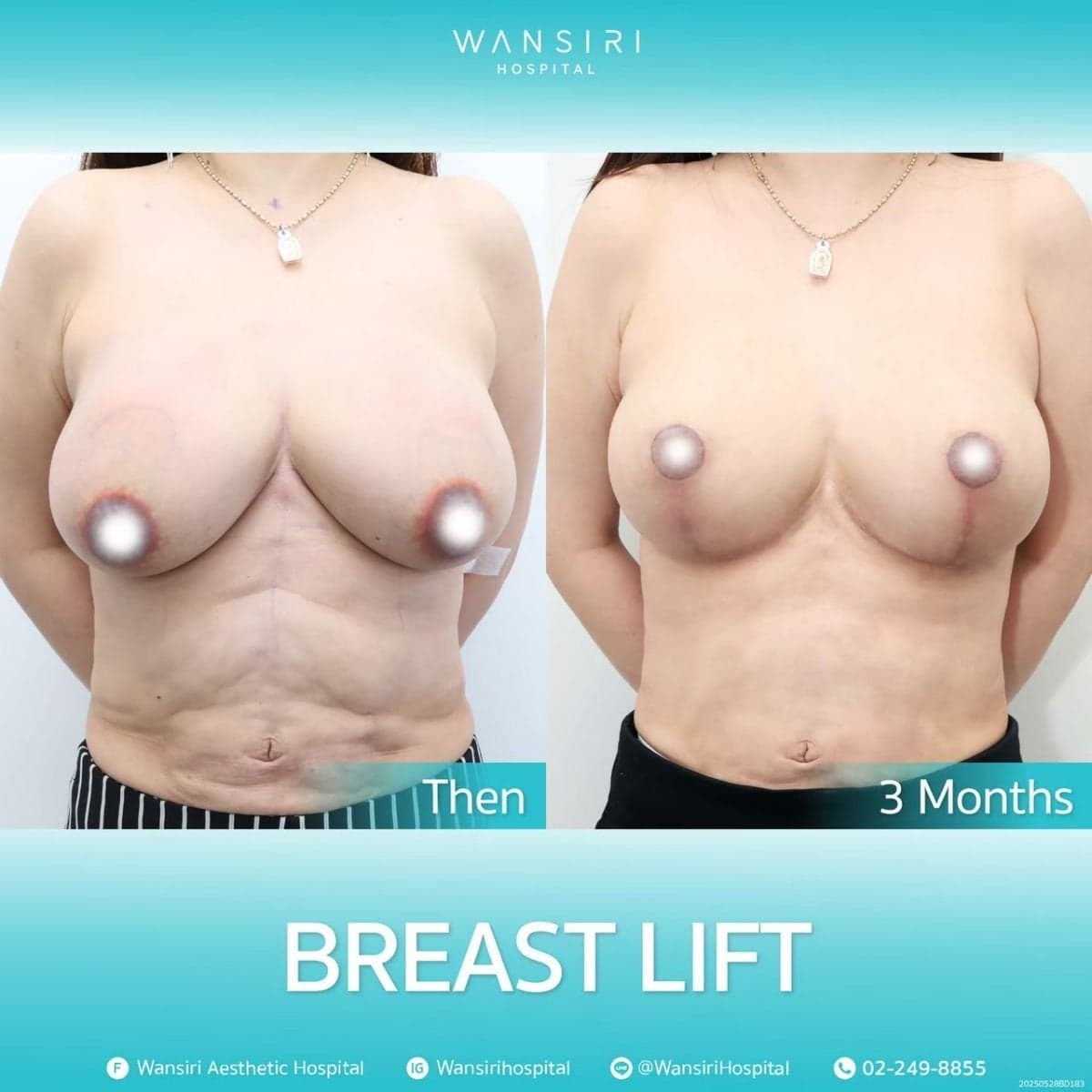 breast lift