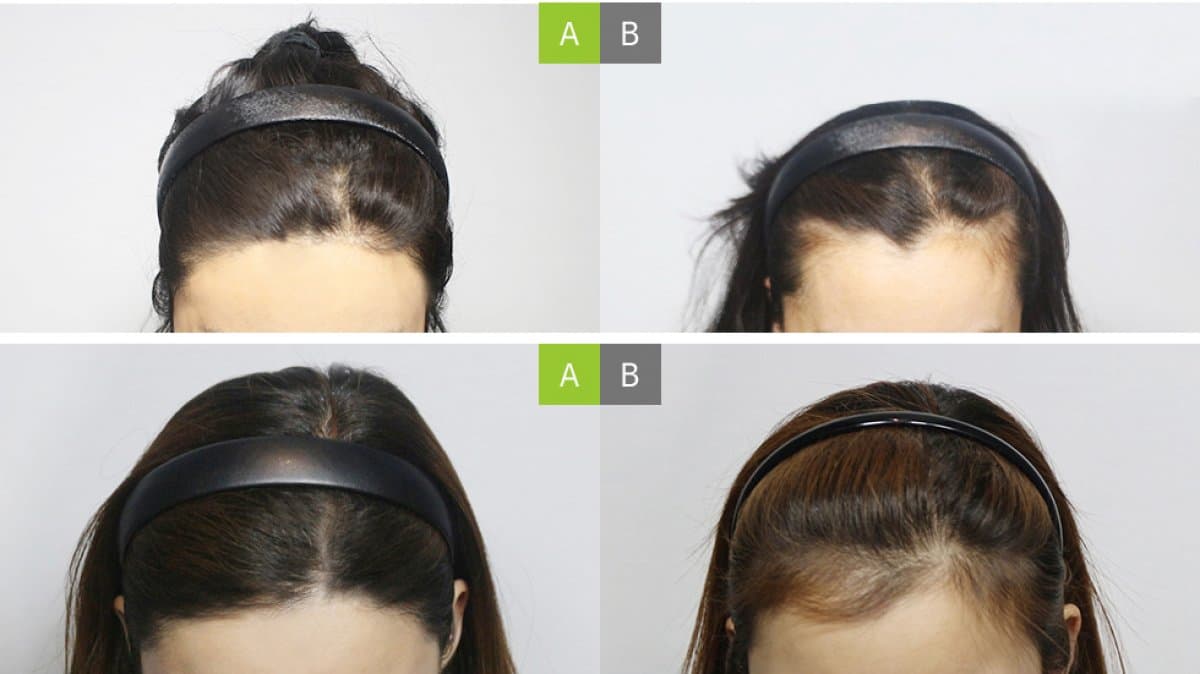 female hair transplant