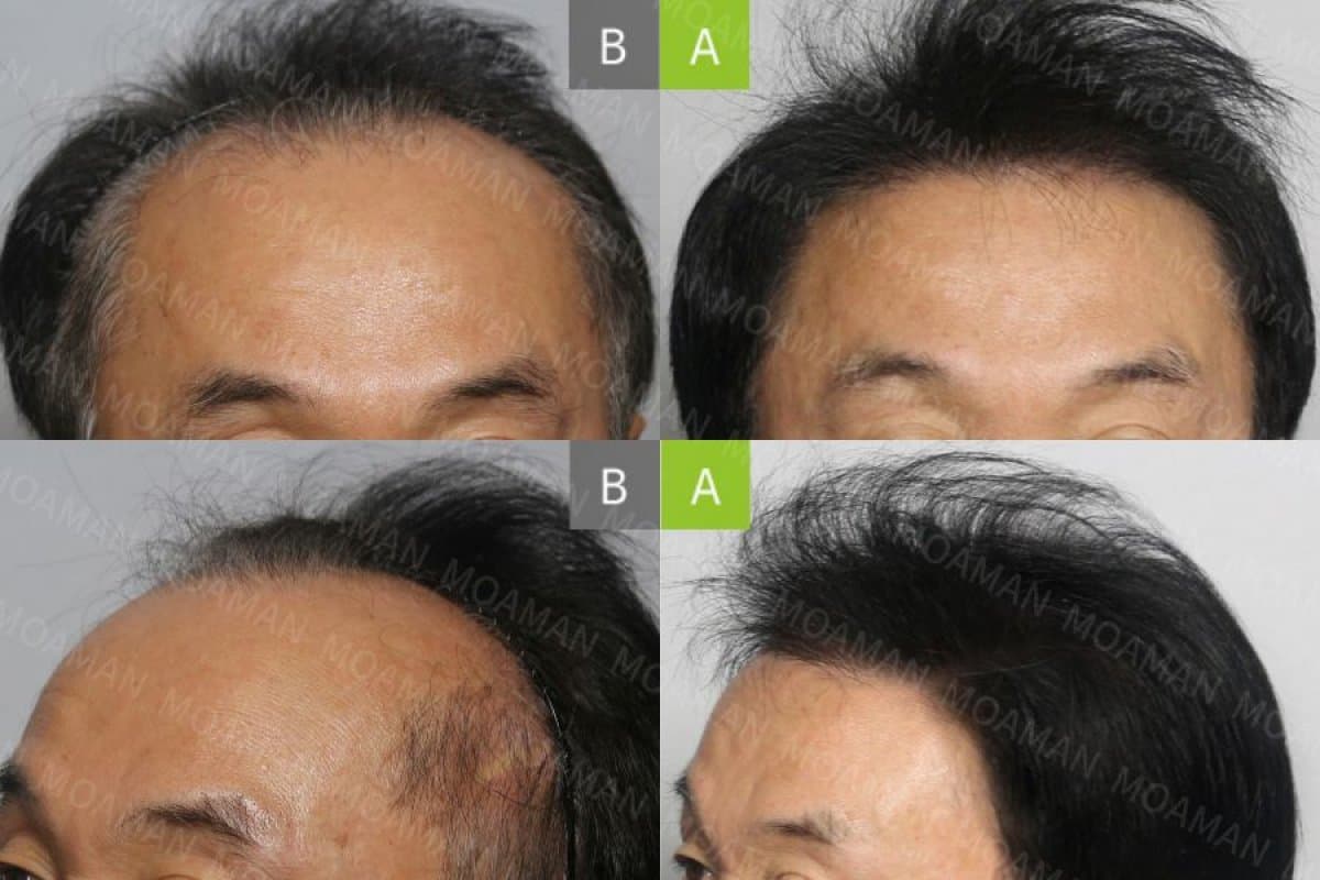 FUE hair transplant