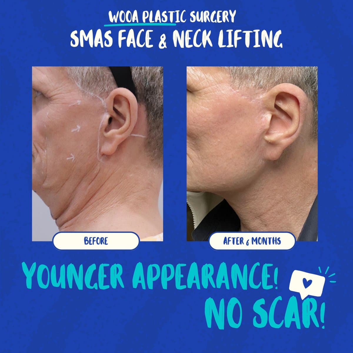 SMAS facelift and neck lift