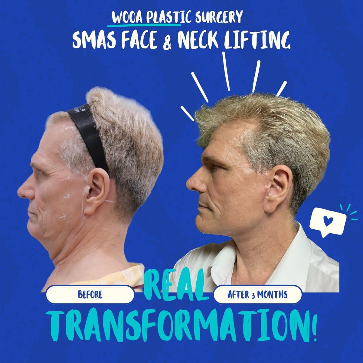 SMAS facelift and neck lift