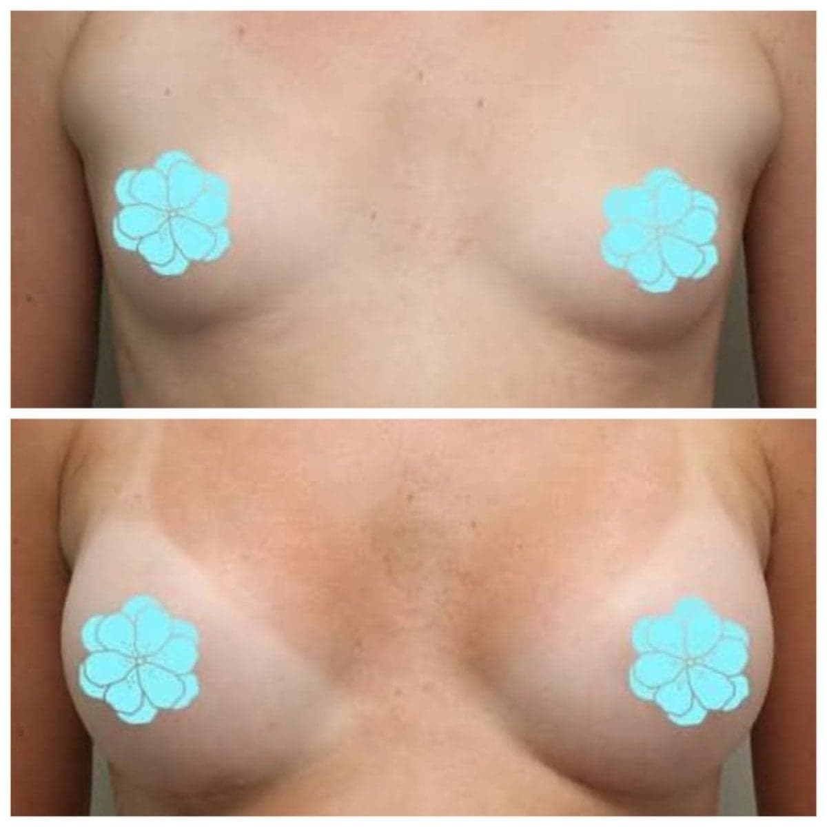 breast augmentation