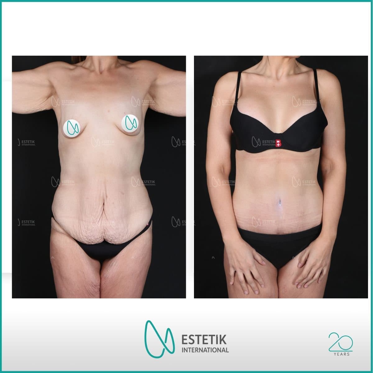 tummy tuck