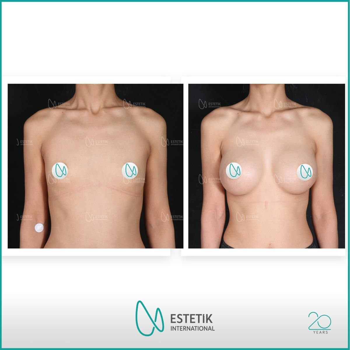 lipofilling breast augmentation