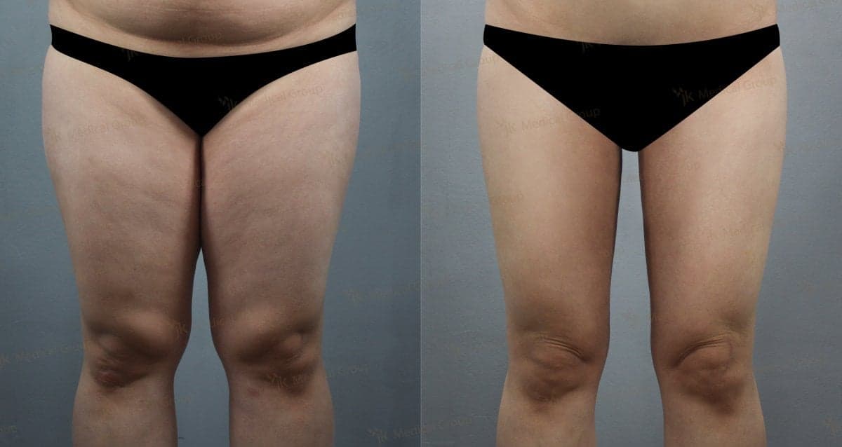 liposuction