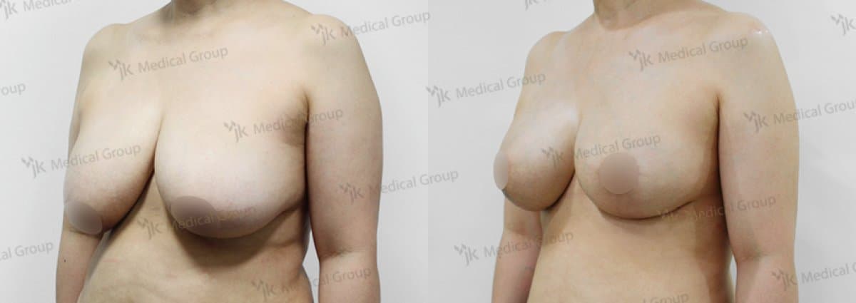 breast reduction