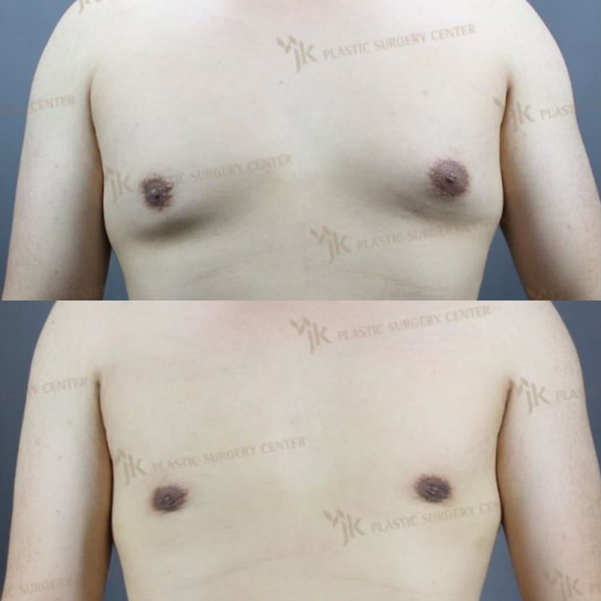 gynecomastia surgery