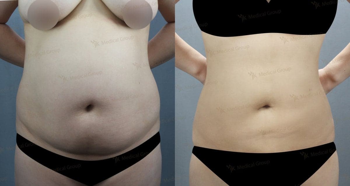 liposuction