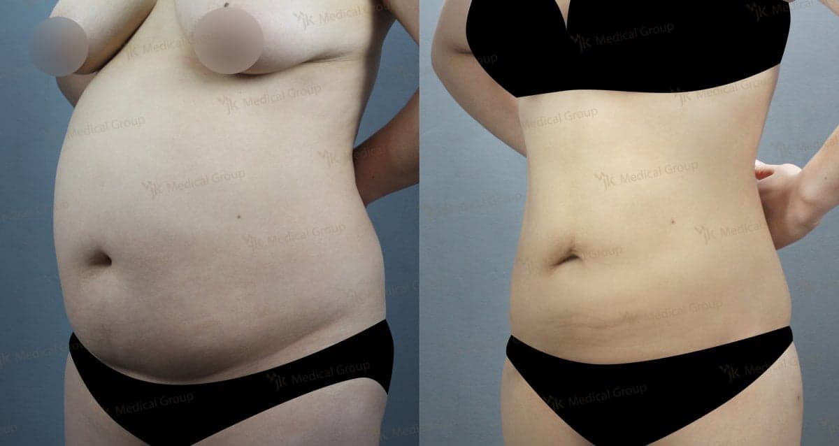 liposuction