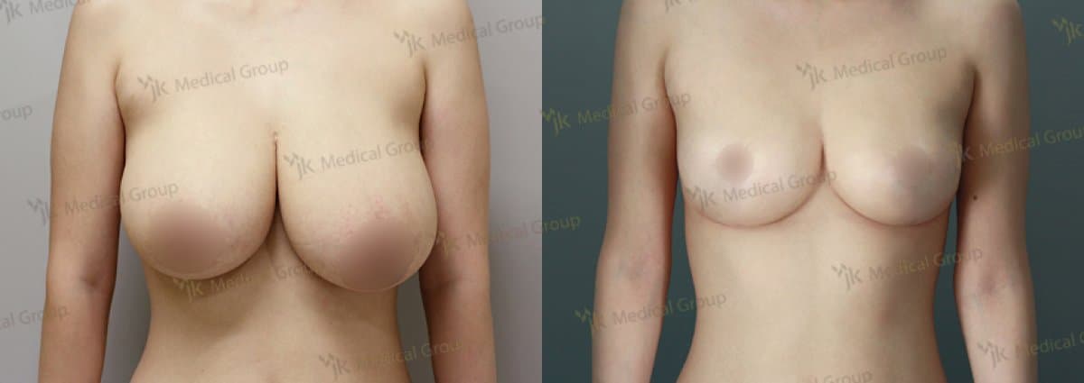 breast reduction