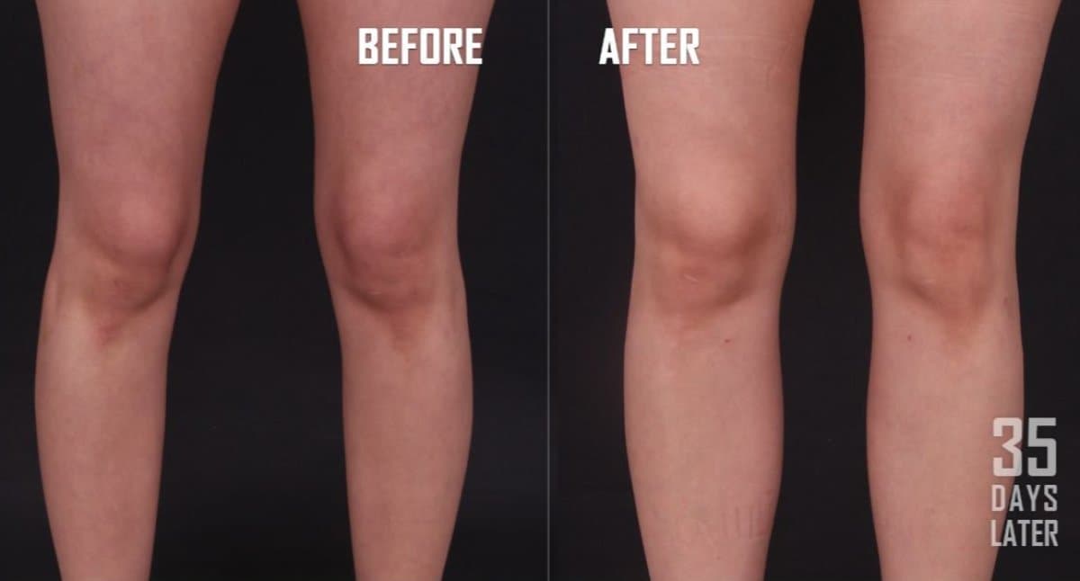 Vaser liposuction