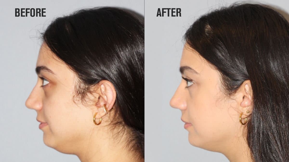 rhinoplasty