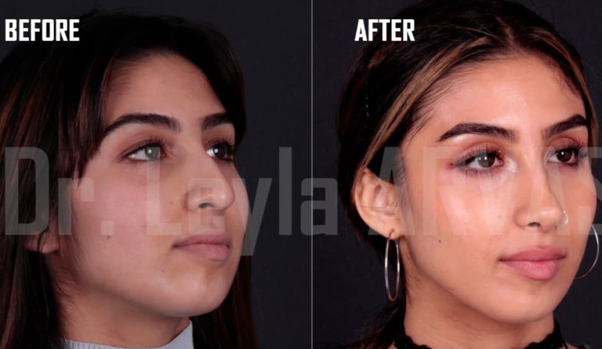 rhinoplasty