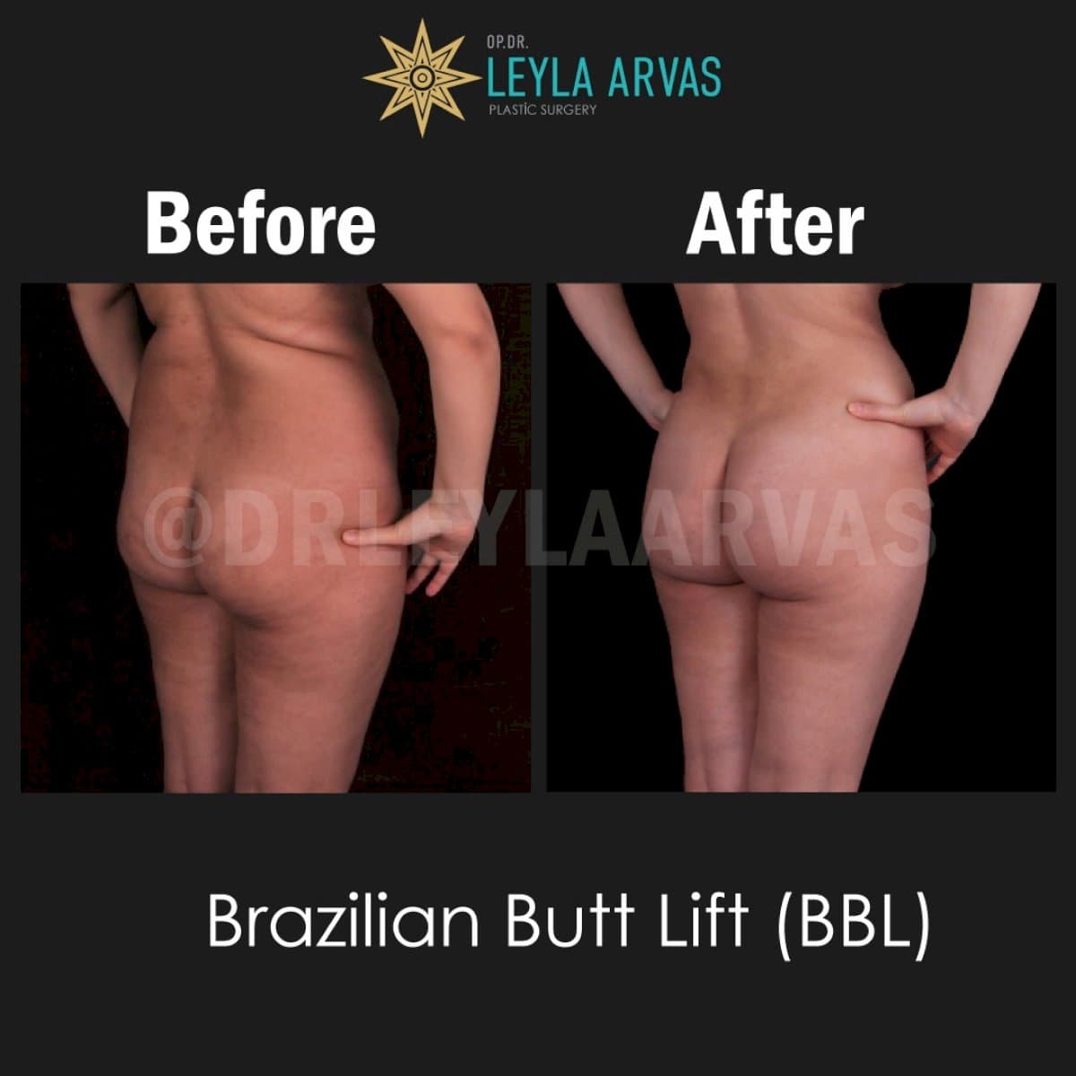 Brazilian Butt Lift