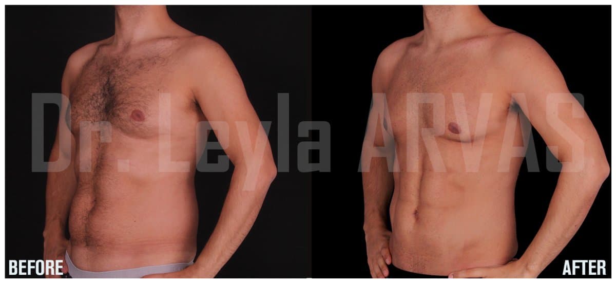 abdominal etching