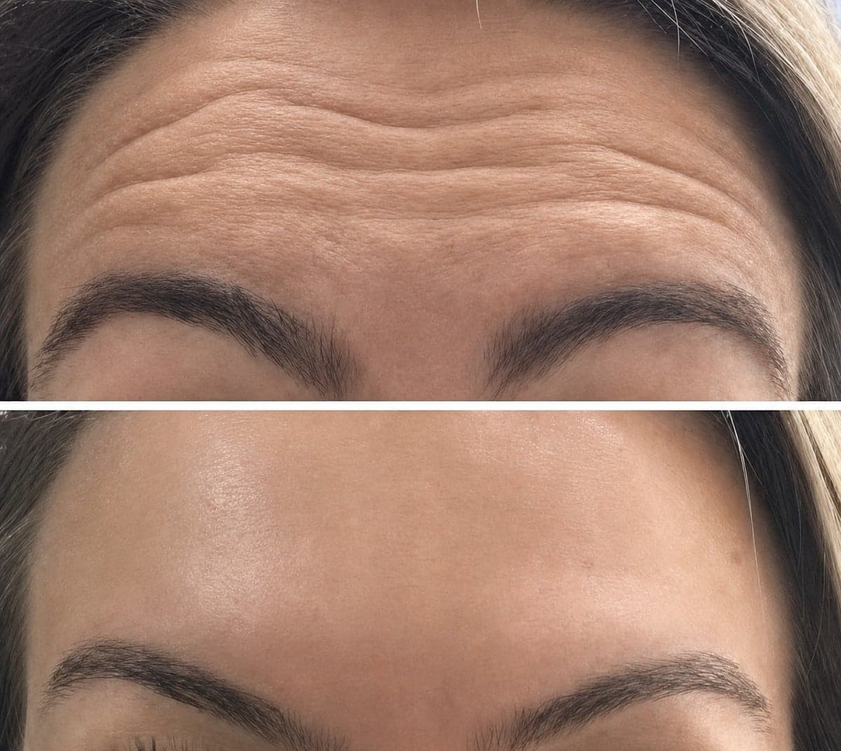 Botox injections