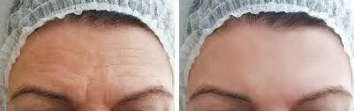Botox injections