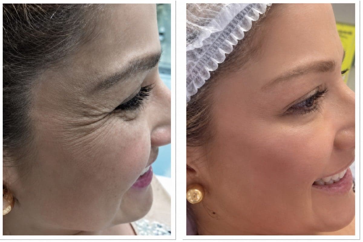 Botox injections