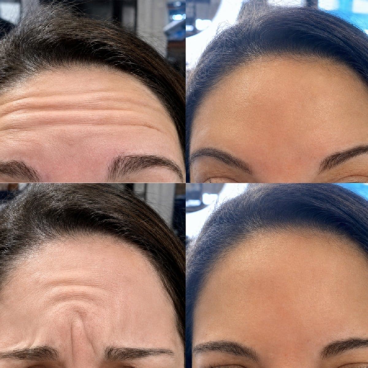 Botox injections