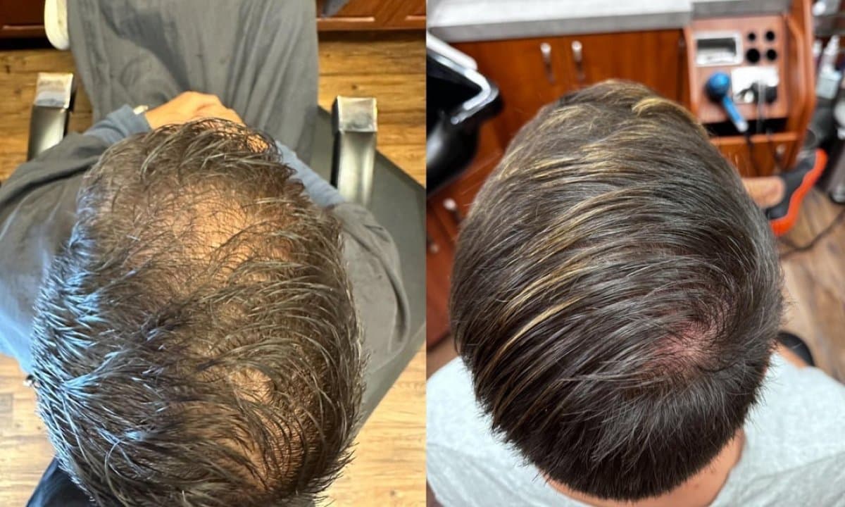 stem cell hair treatment