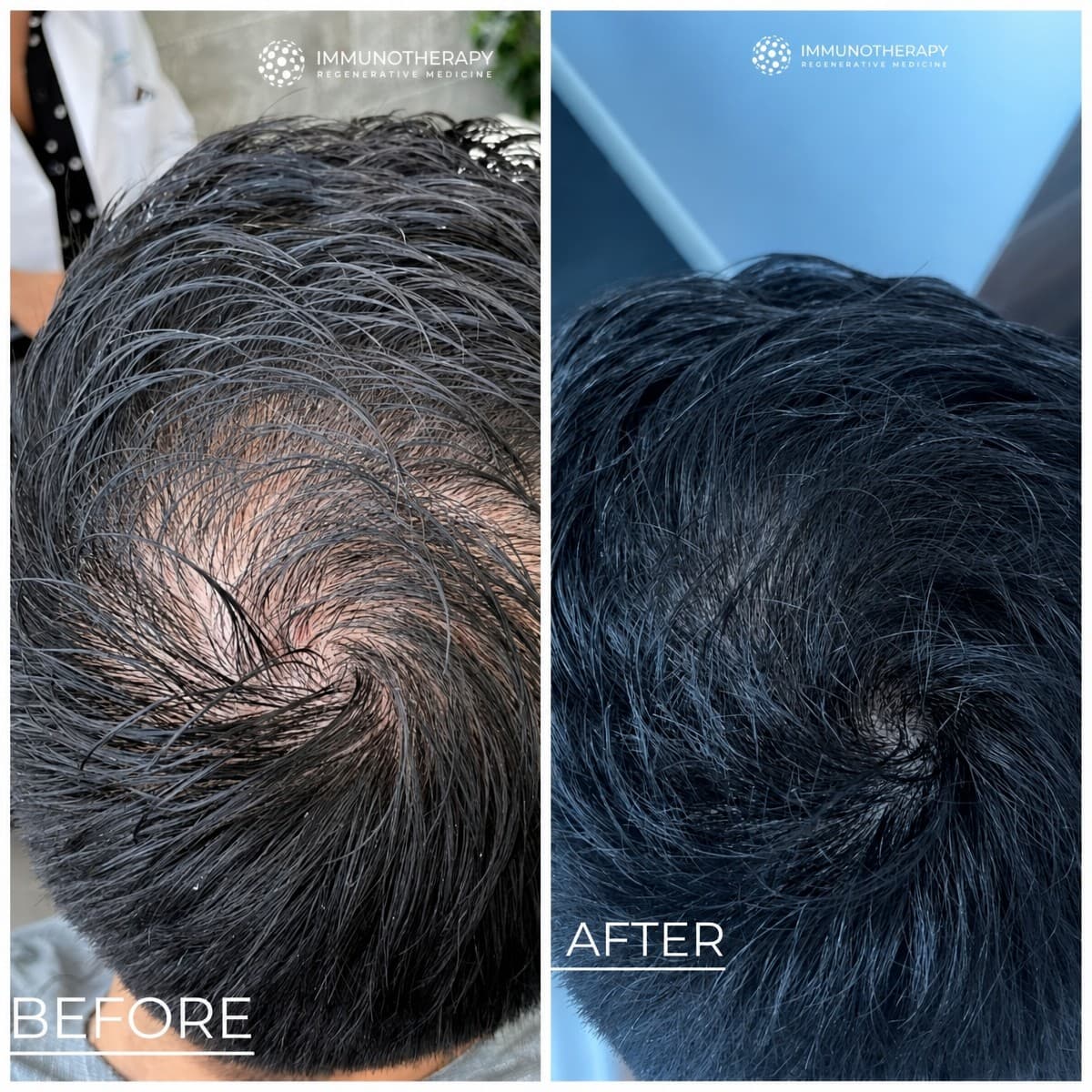 stem cell hair treatment
