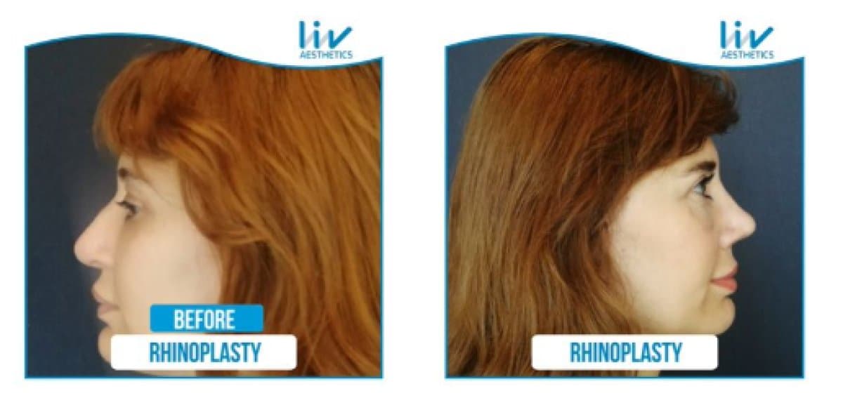 rhinoplasty