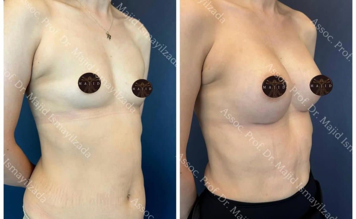 breast augmentation