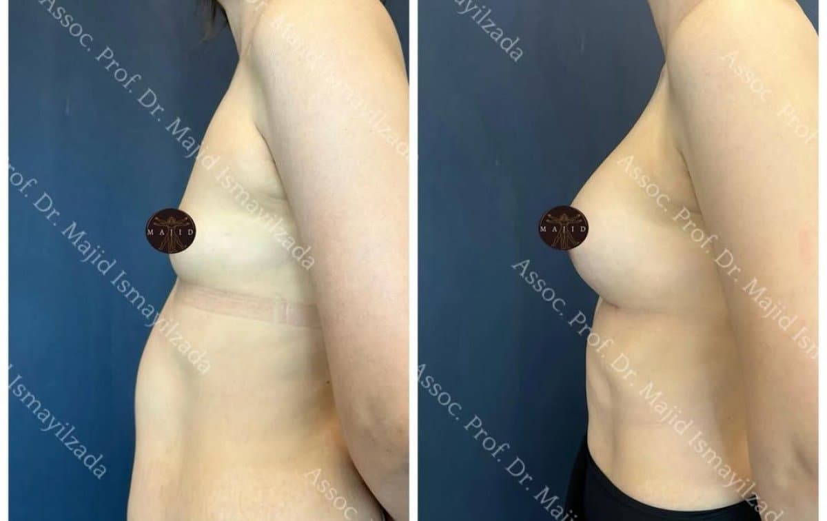 breast augmentation
