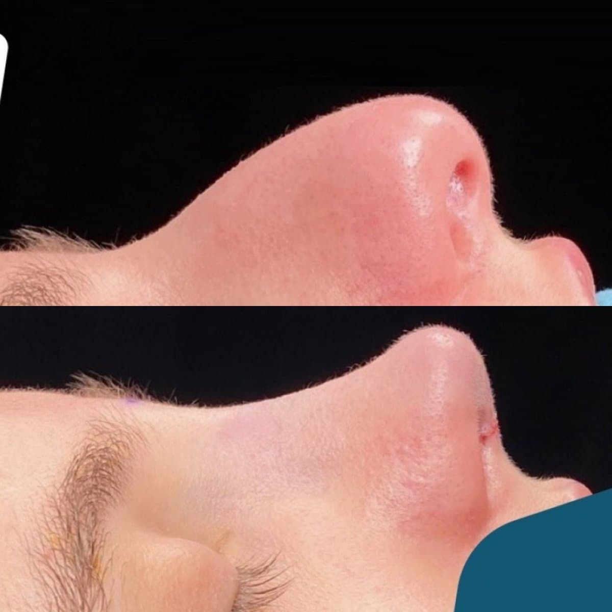 rhinoplasty