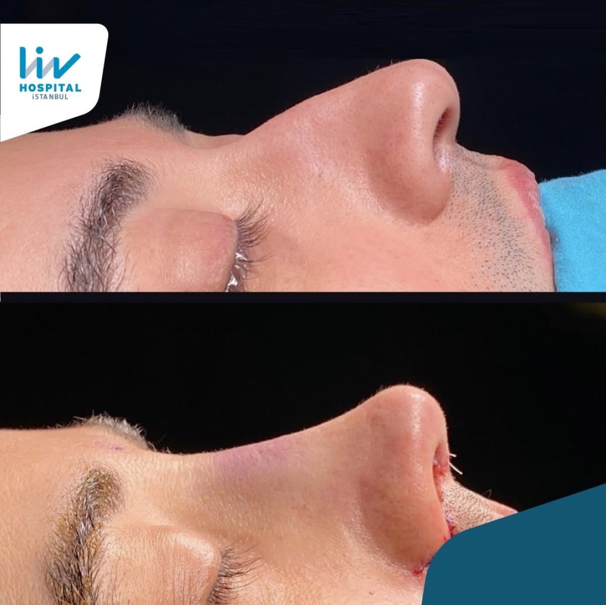 rhinoplasty