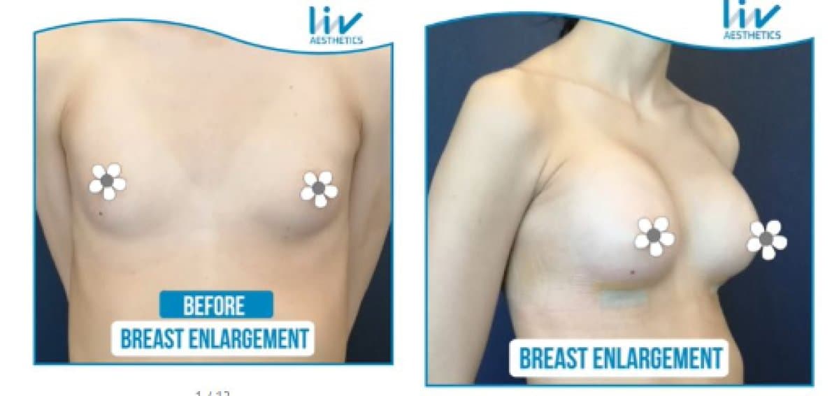breast enlargement