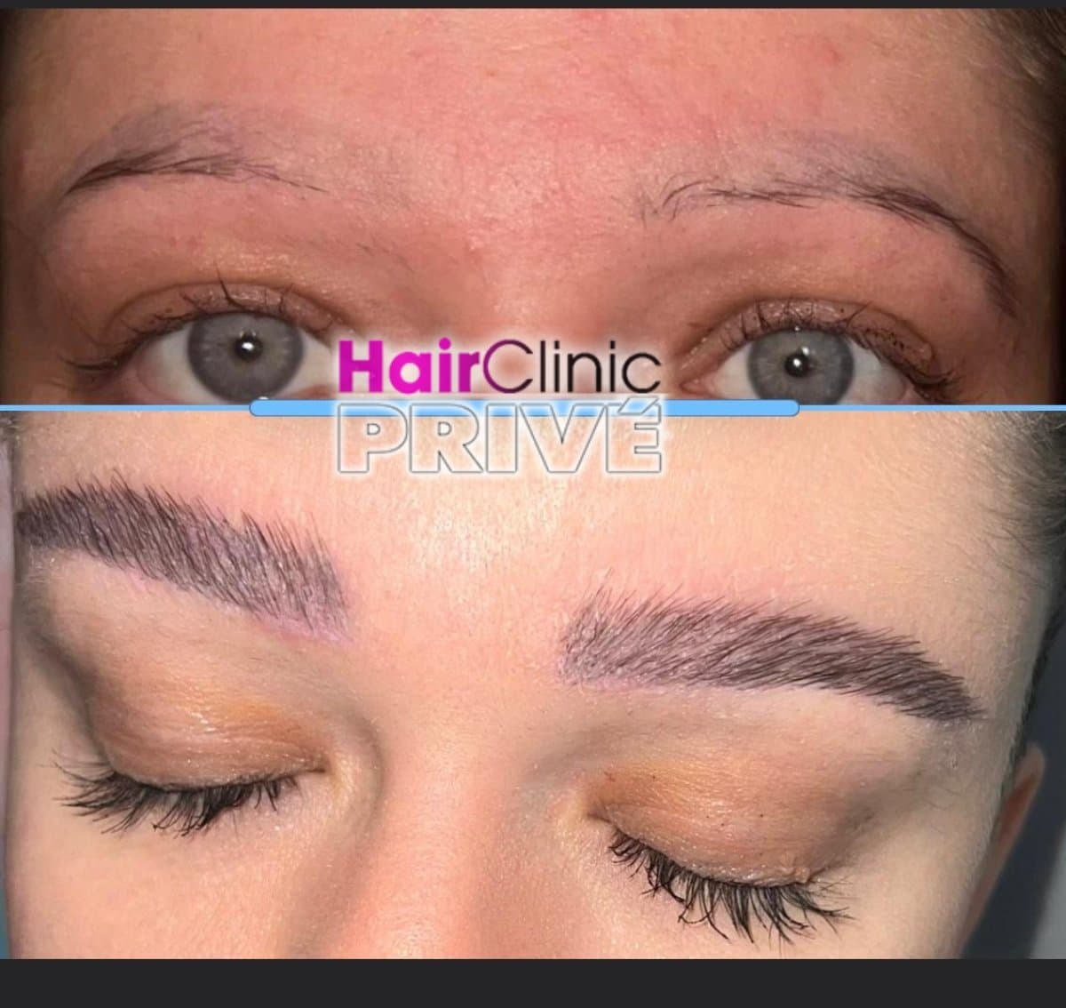 eyebrow transplant
