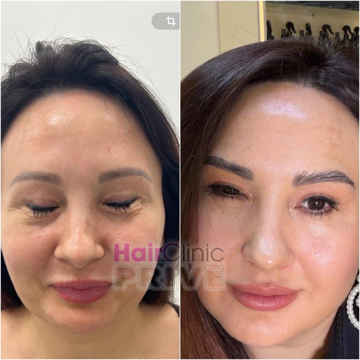 facial rejuvenation