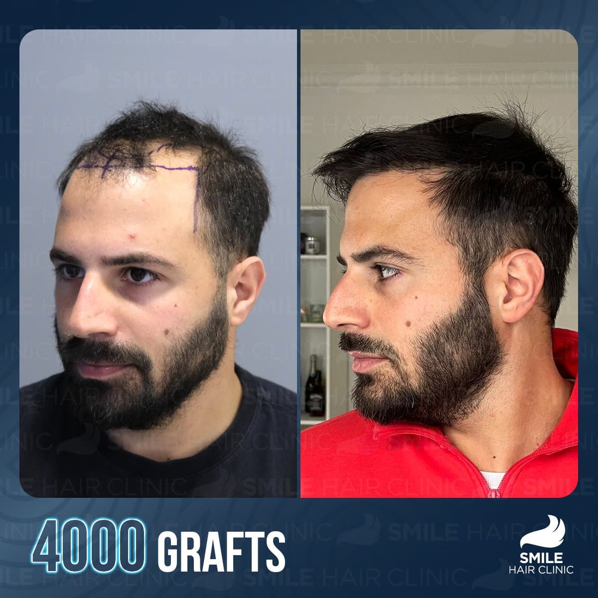 result with 4000 grafts
