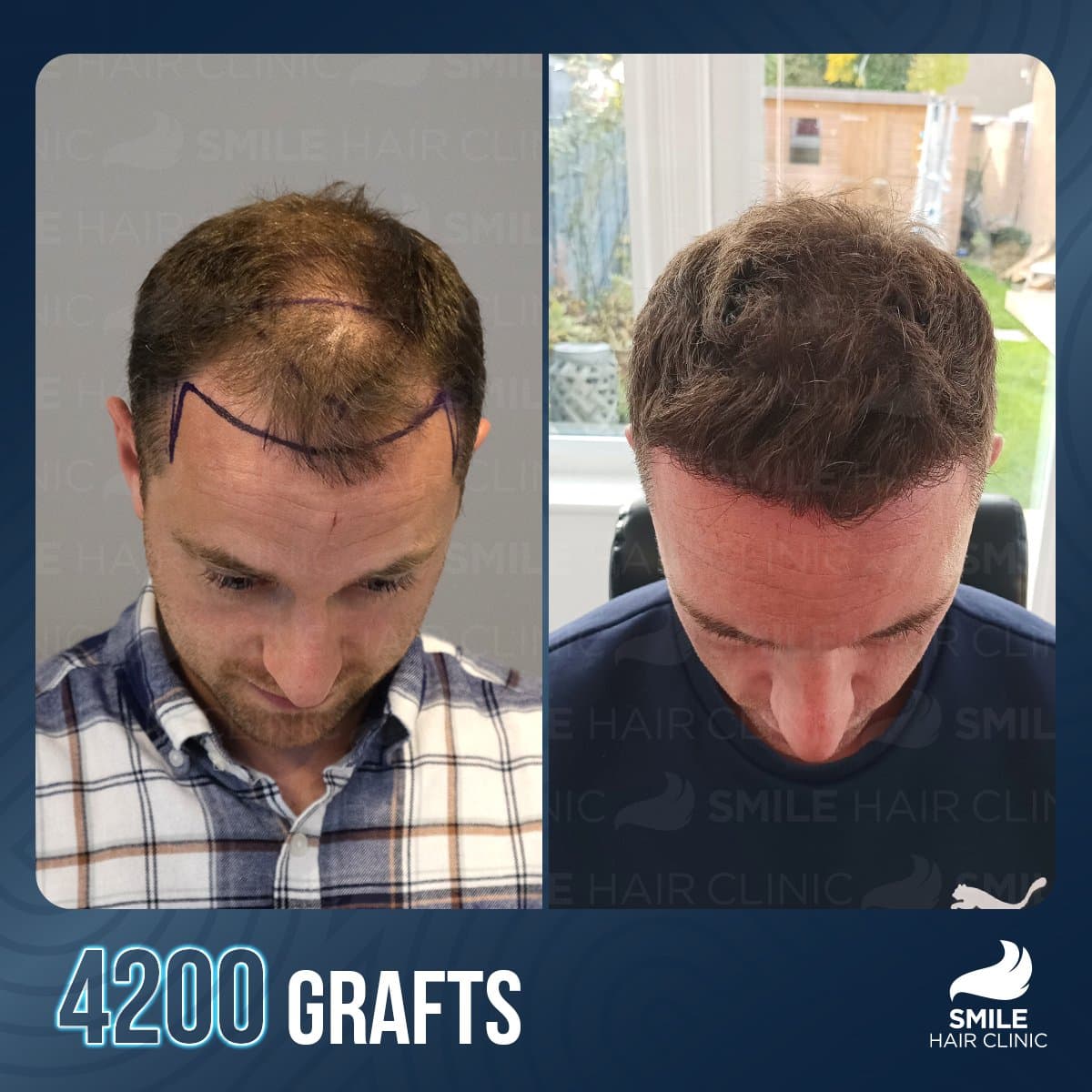 FUE hair transplant