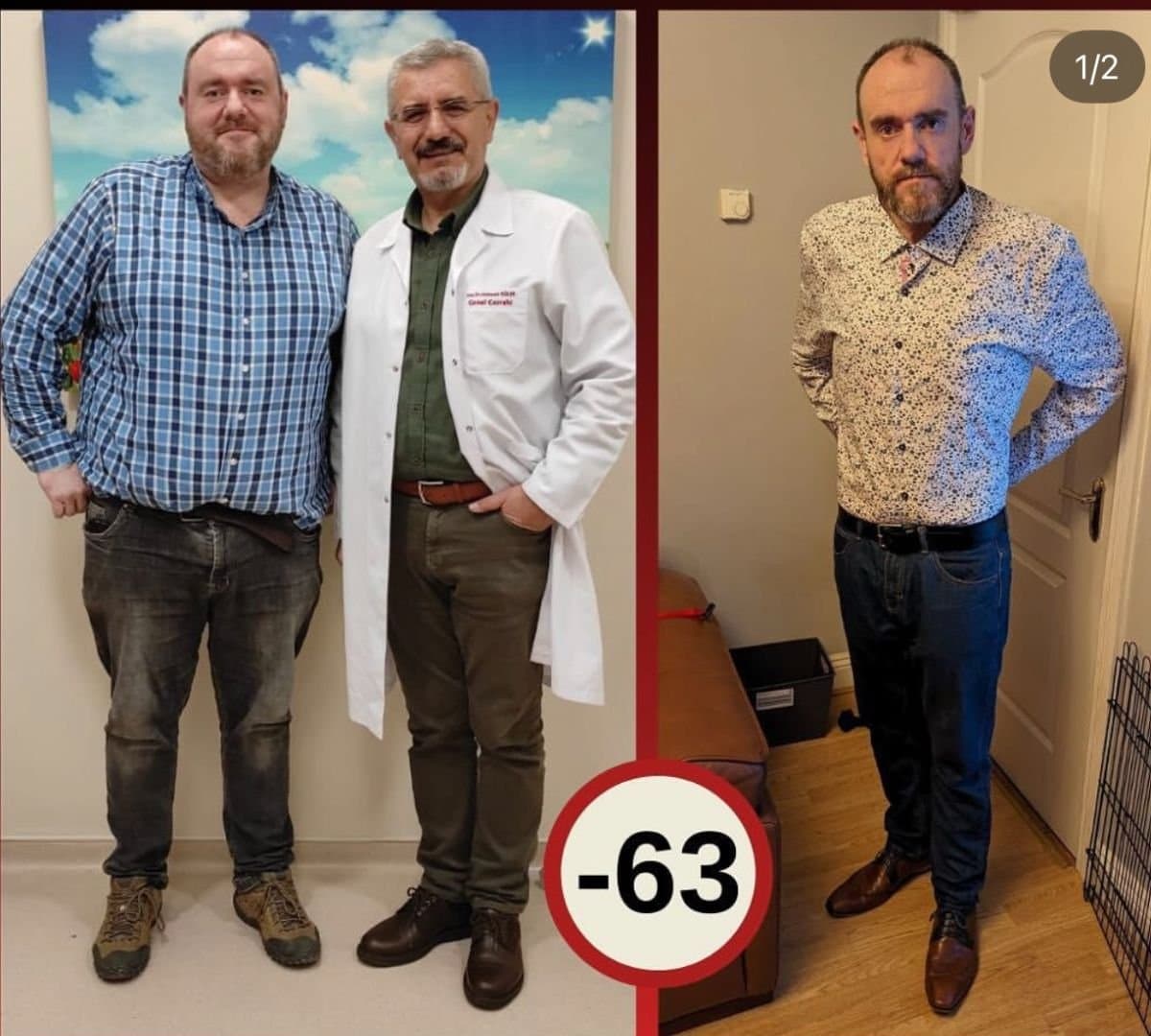 gastric sleeve surgery