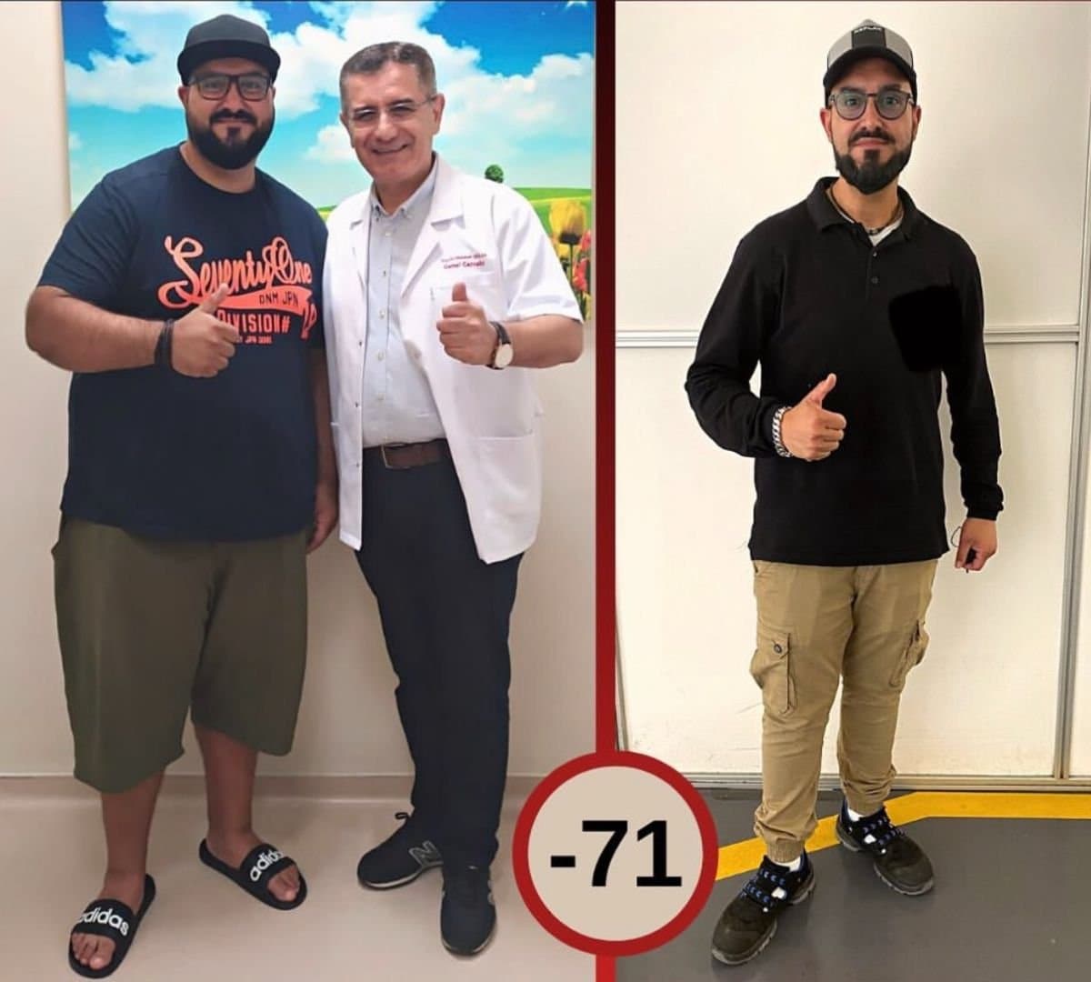 gastric sleeve surgery