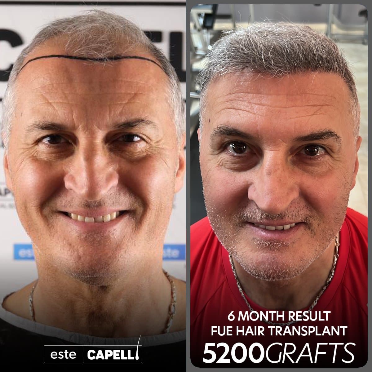 FUT hair transplant