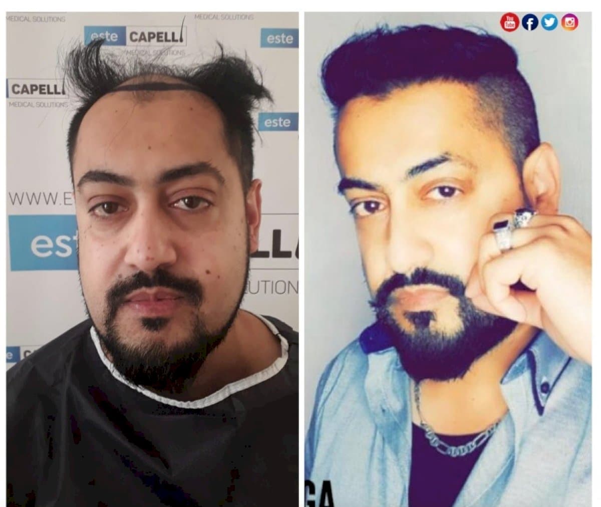 FUE hair transplant