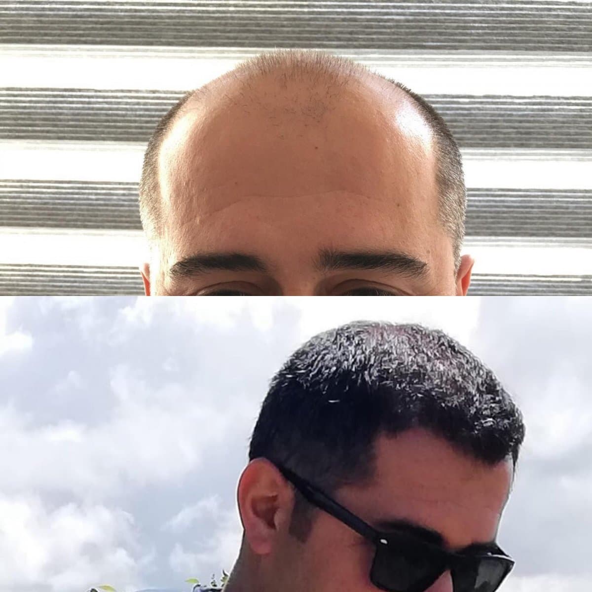 hair transplant