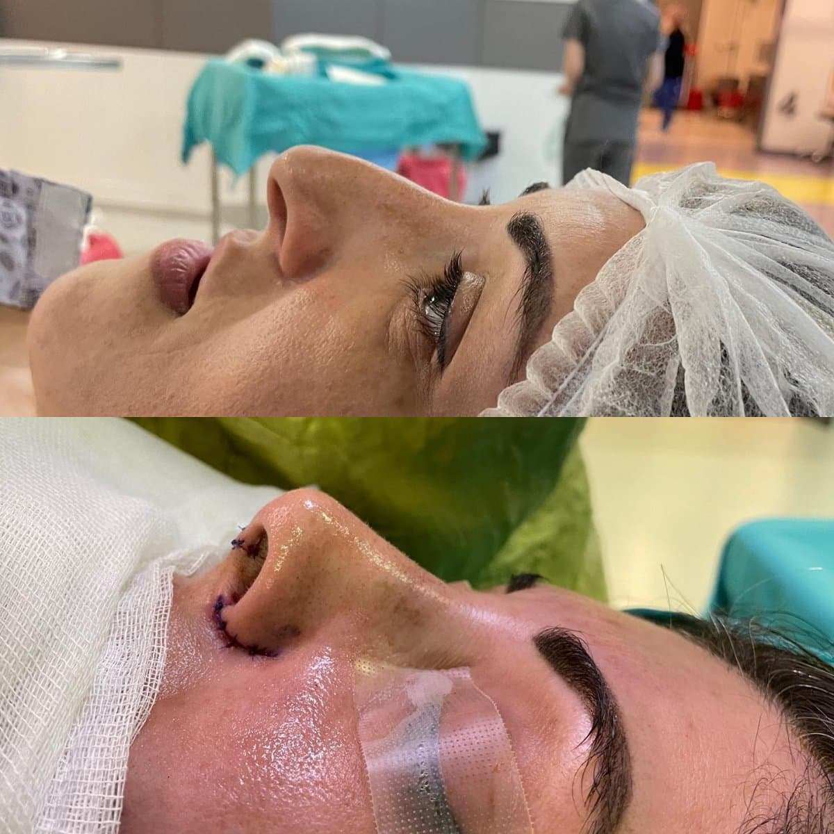 rhinoplasty